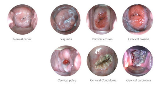 Máy soi cổ tử cung điện tử kỹ thuật số di động