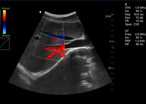 Máy Doppler màu kỹ thuật số đầy đủ 15 inch Siêu âm Doppler hình ảnh di động với 2 cổng USB