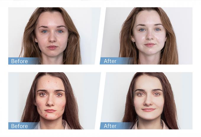 Bán hàng tại xưởng Bút Hydra Pen H5 EMS Điện Microneedling cho Tái tạo Collagen Mọc Tóc Râu Tại nhà và Sử dụng tại Salon 4